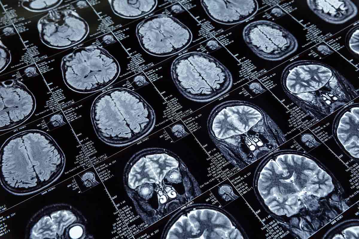 Topografia mozgu s Alzheimerovou chorobou